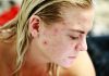 REASONS YOU MIGHT BE HAVING ACNE acne