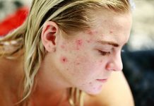 REASONS YOU MIGHT BE HAVING ACNE acne