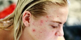 REASONS YOU MIGHT BE HAVING ACNE acne