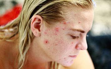 REASONS YOU MIGHT BE HAVING ACNE acne