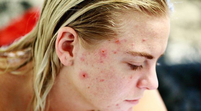 REASONS YOU MIGHT BE HAVING ACNE acne